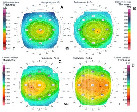 human corneal thickness